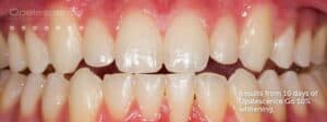teeth after whitening procedure