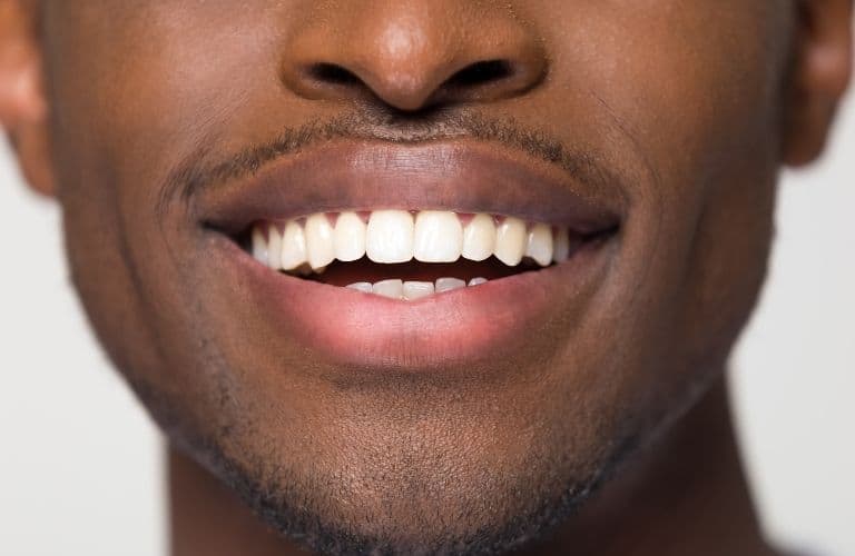 Are Clear Aligners Worth It? Cost, Benefits and Long-Term Results