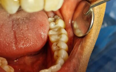 Managing Wisdom Tooth Pain and Soreness