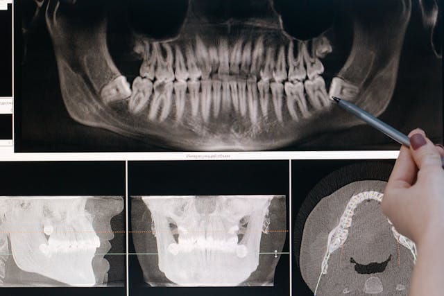 wisdom tooth extraction