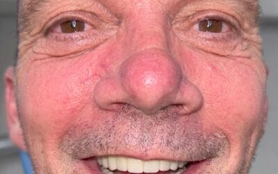 Case Study: Full Mouth Rehabilitation with 10 Dental Implants
