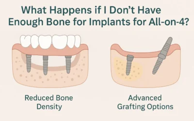 What Happens if I Don’t Have Enough Bone for Implants for All-on-4?